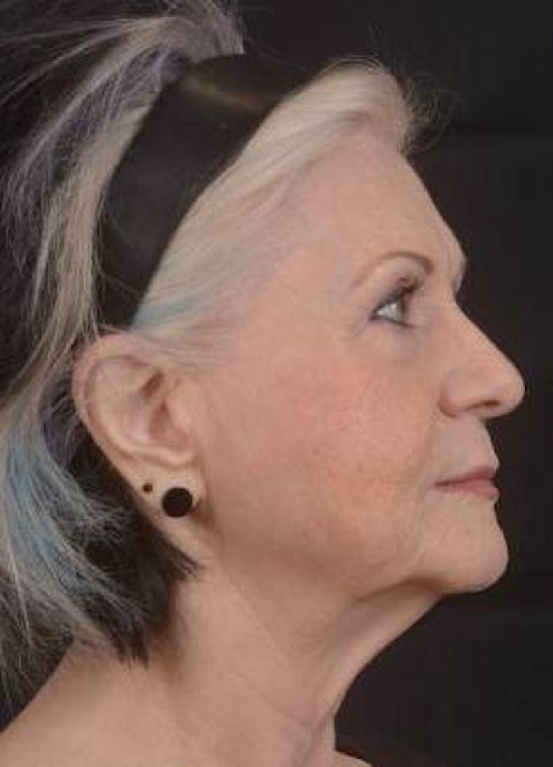 Facelift Before & After Gallery - Patient 385952 - Image 9