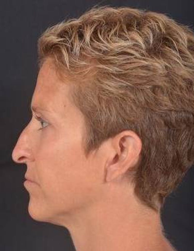 Rhinoplasty Before & After Gallery - Patient 394002 - Image 3