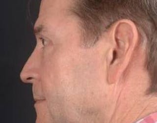 Blepharoplasty Before & After Gallery - Patient 254252 - Image 4