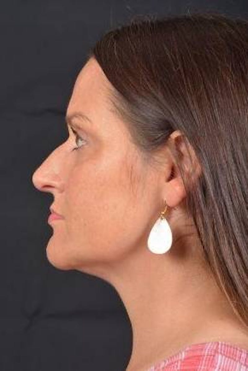 FaceTite Before & After Gallery - Patient 184387 - Image 4