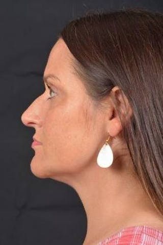 FaceTite Before & After Gallery - Patient 184387 - Image 4