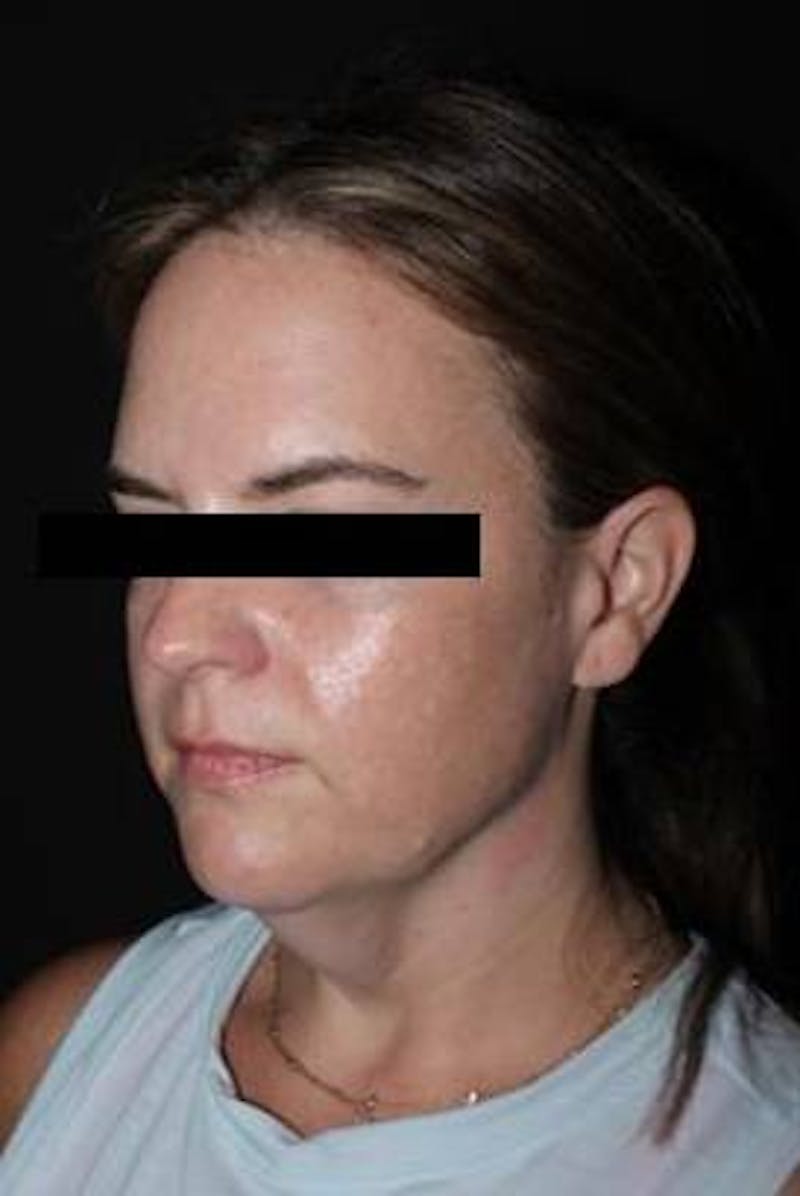 Necklift Before & After Gallery - Patient 309823 - Image 3