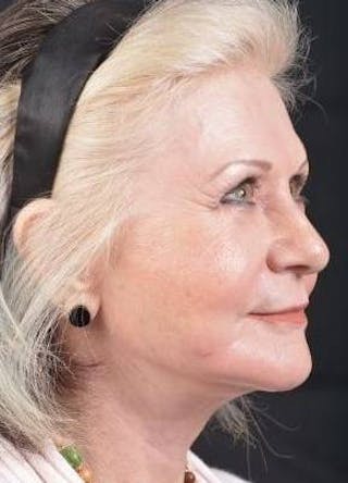 Facelift Before & After Gallery - Patient 385952 - Image 10