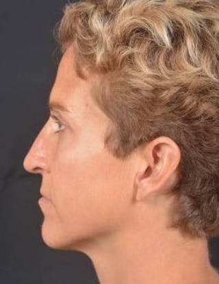 Rhinoplasty Before & After Gallery - Patient 394002 - Image 4