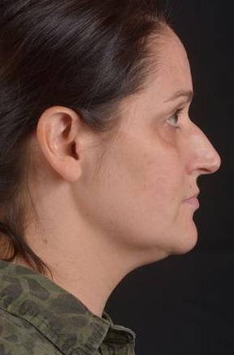 FaceTite Before & After Gallery - Patient 184387 - Image 5