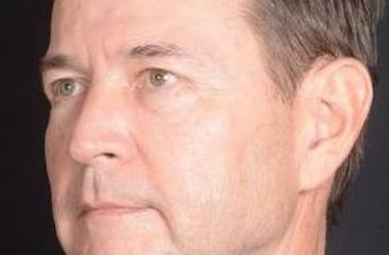 Blepharoplasty Before & After Gallery - Patient 254252 - Image 7