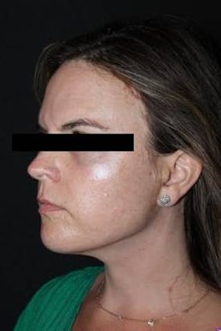 Necklift Before & After Gallery - Patient 309823 - Image 4