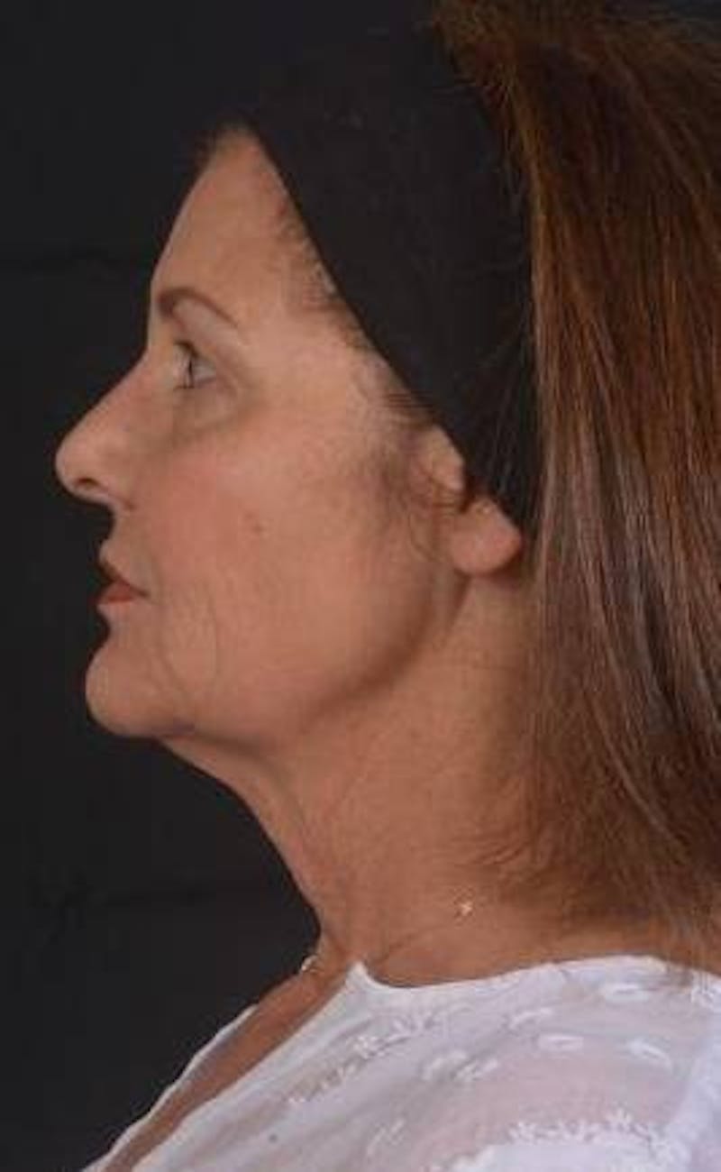Facelift Before & After Gallery - Patient 190358 - Image 3