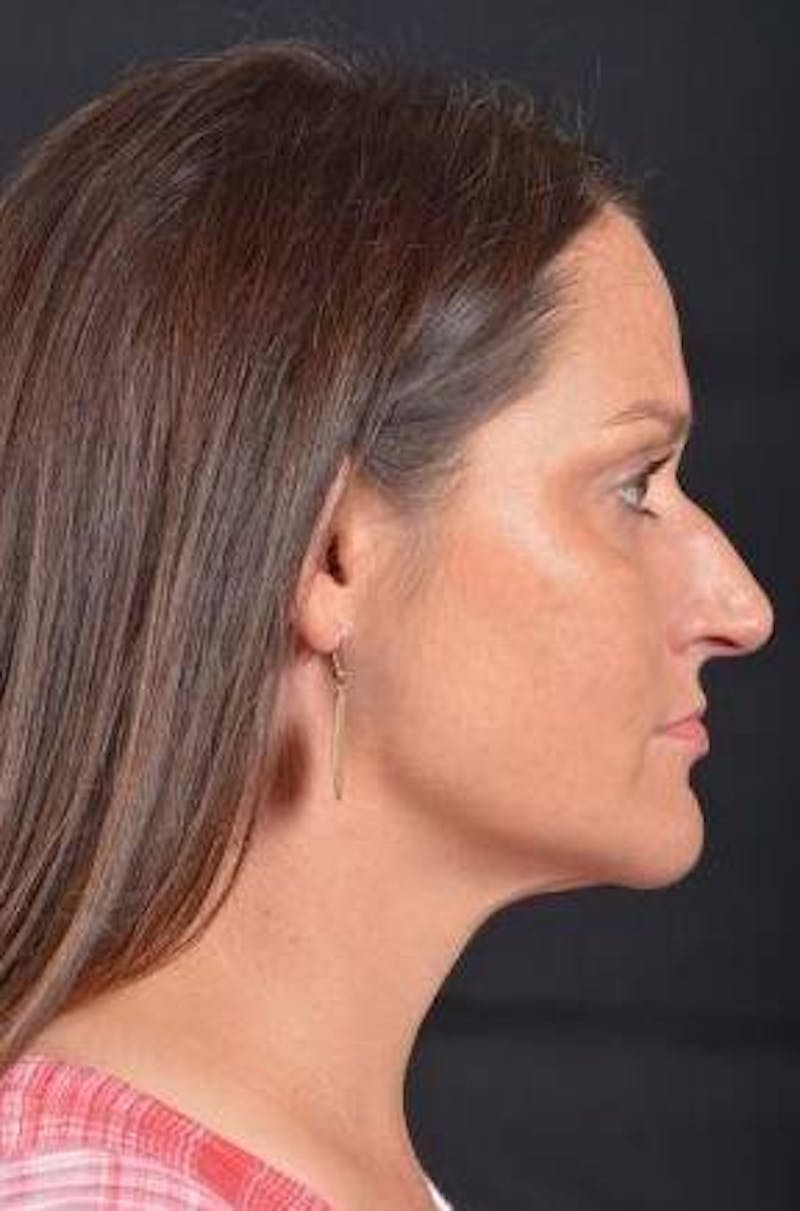 FaceTite Before & After Gallery - Patient 184387 - Image 6