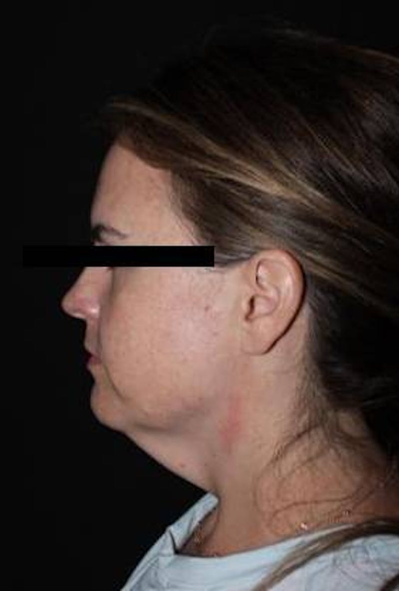 Necklift Before & After Gallery - Patient 309823 - Image 5