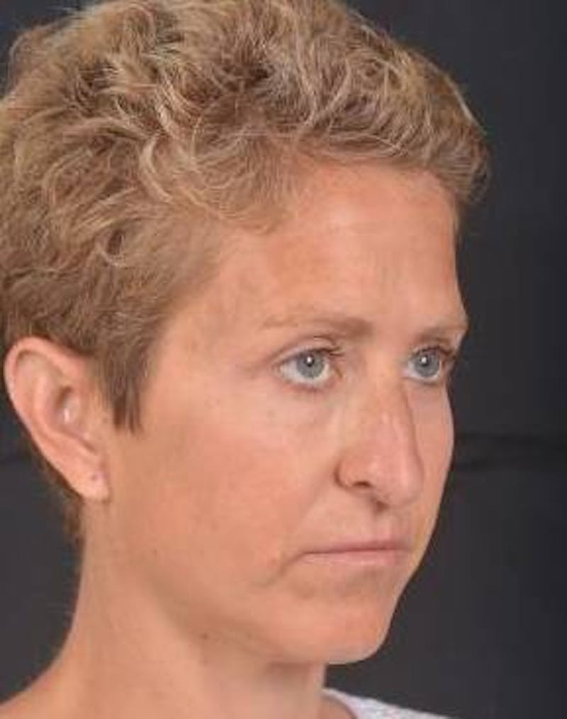 Rhinoplasty Before & After Gallery - Patient 394002 - Image 9