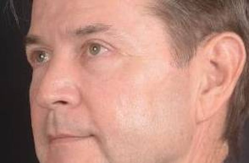 Blepharoplasty Before & After Gallery - Patient 254252 - Image 8