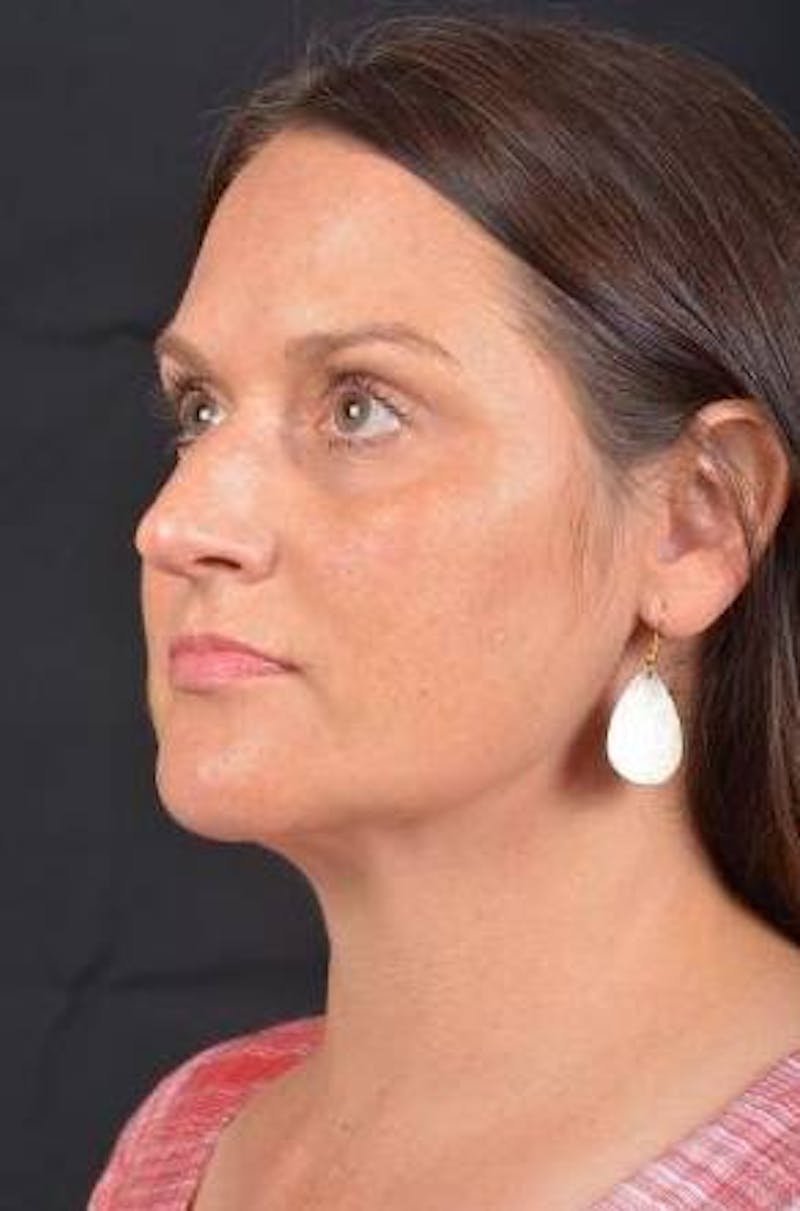 FaceTite Before & After Gallery - Patient 184387 - Image 8