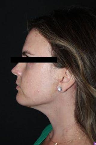 Necklift Before & After Gallery - Patient 309823 - Image 6