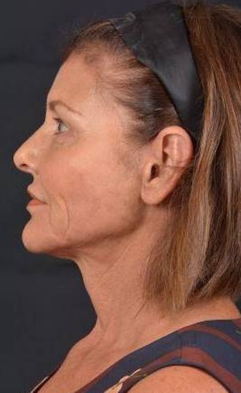 Facelift Before & After Gallery - Patient 190358 - Image 4