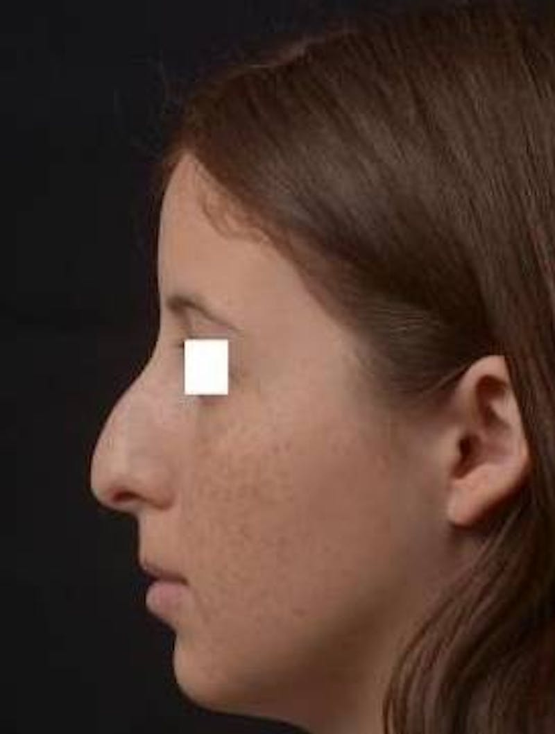 Rhinoplasty Before & After Gallery - Patient 222295 - Image 3