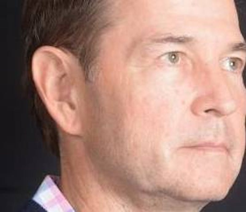 Blepharoplasty Before & After Gallery - Patient 254252 - Image 9