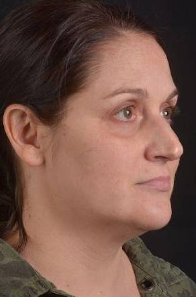FaceTite Before & After Gallery - Patient 184387 - Image 9