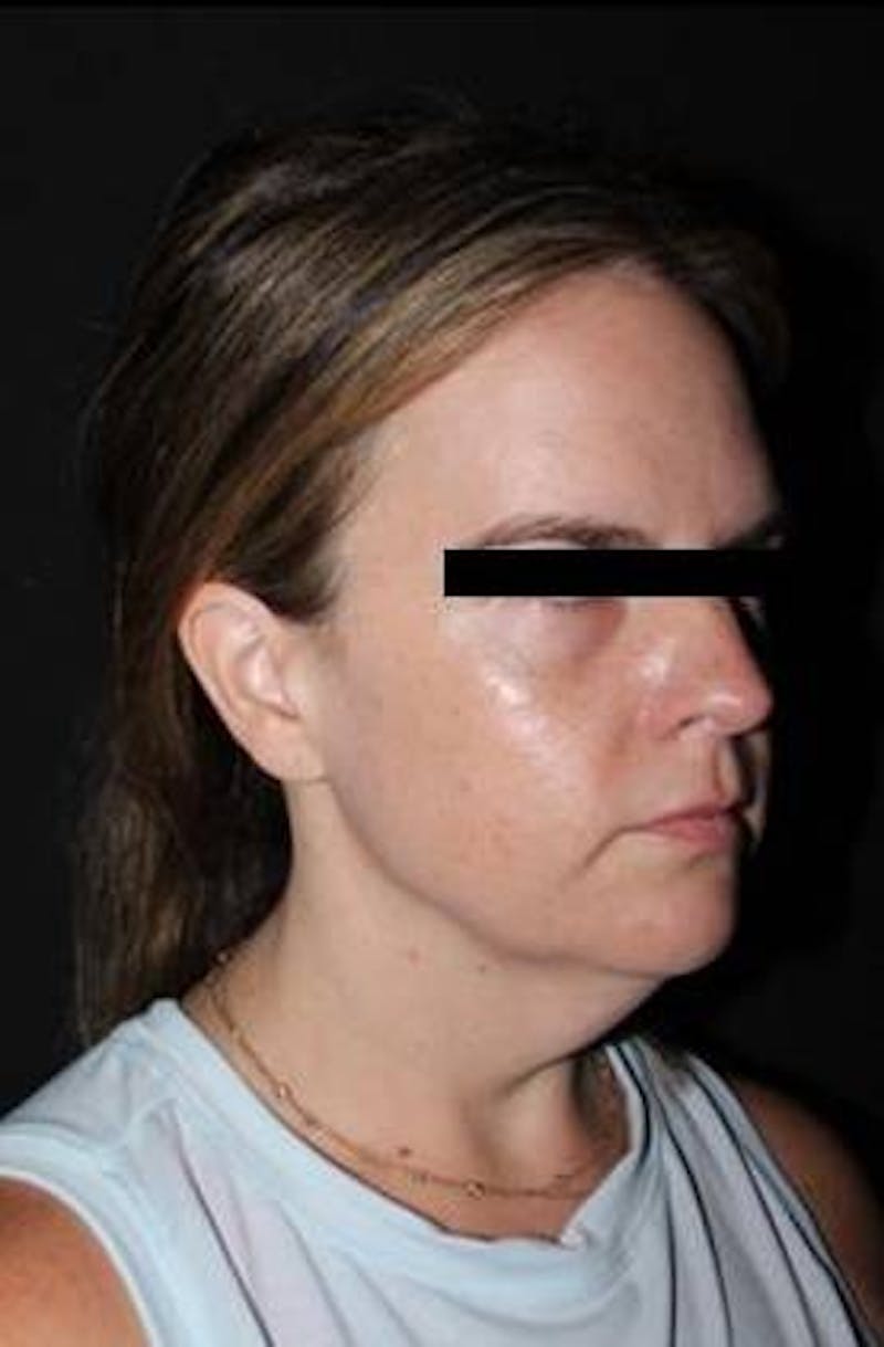 Necklift Before & After Gallery - Patient 309823 - Image 7