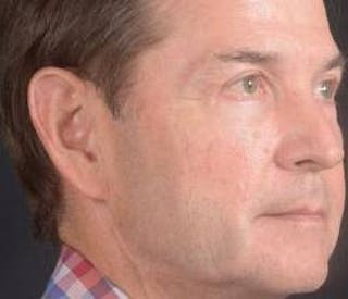 Blepharoplasty Before & After Gallery - Patient 254252 - Image 10