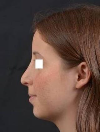 Rhinoplasty Before & After Gallery - Patient 222295 - Image 4