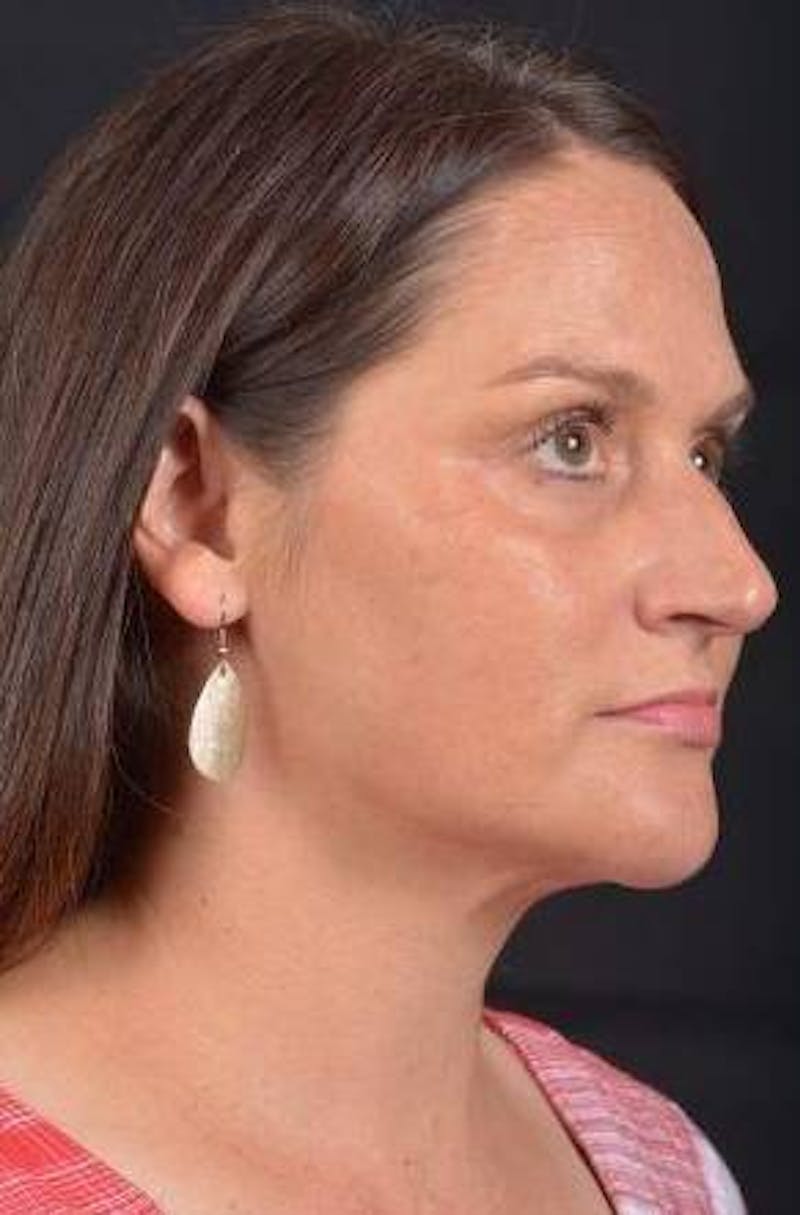 FaceTite Before & After Gallery - Patient 184387 - Image 10