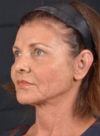 Facelift Before & After Gallery - Patient 190358 - Image 8