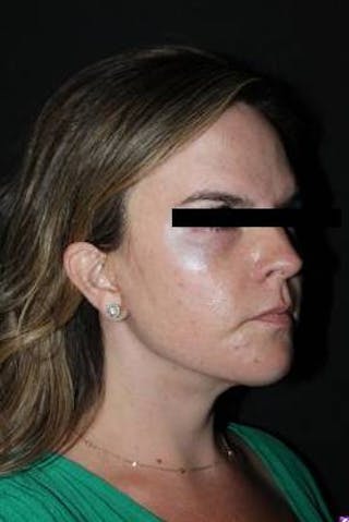 Necklift Before & After Gallery - Patient 309823 - Image 8