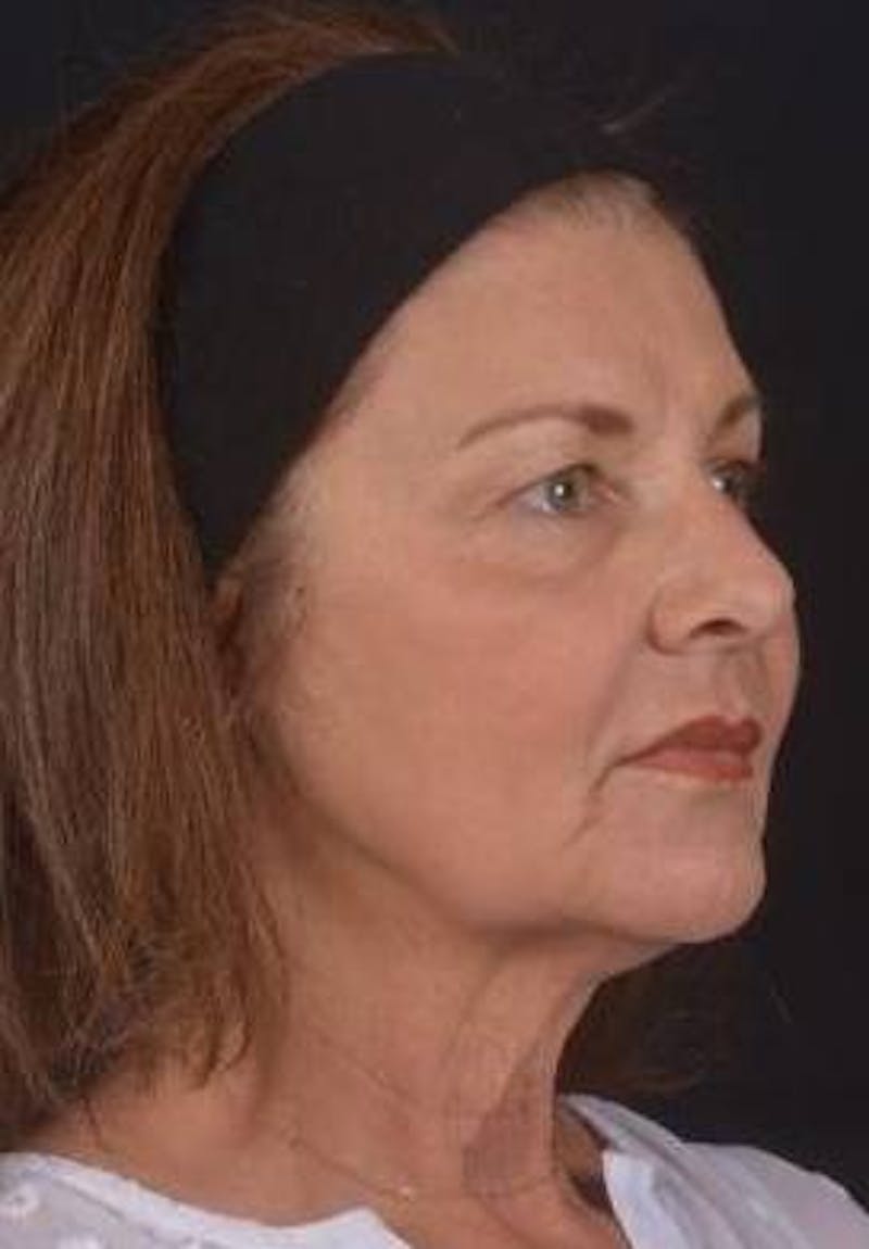 Facelift Before & After Gallery - Patient 190358 - Image 9