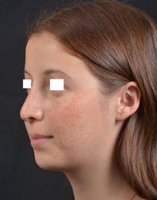 Rhinoplasty Before & After Gallery - Patient 222295 - Image 8