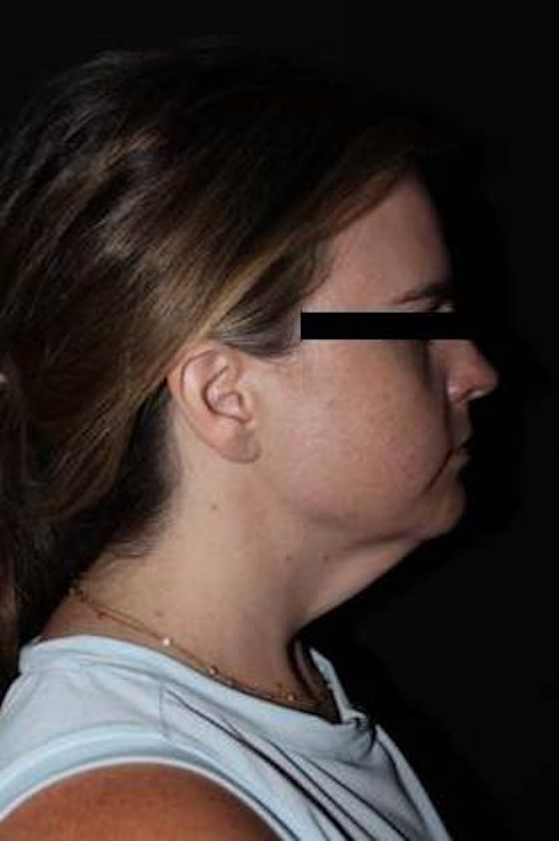 Necklift Before & After Gallery - Patient 309823 - Image 9