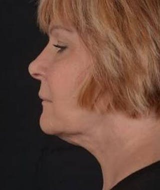 FaceTite Before & After Gallery - Patient 350944 - Image 4