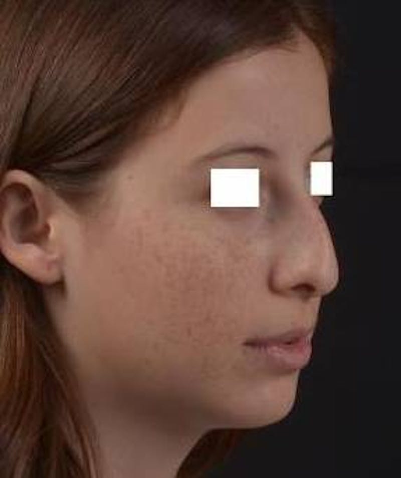 Rhinoplasty Before & After Gallery - Patient 222295 - Image 9