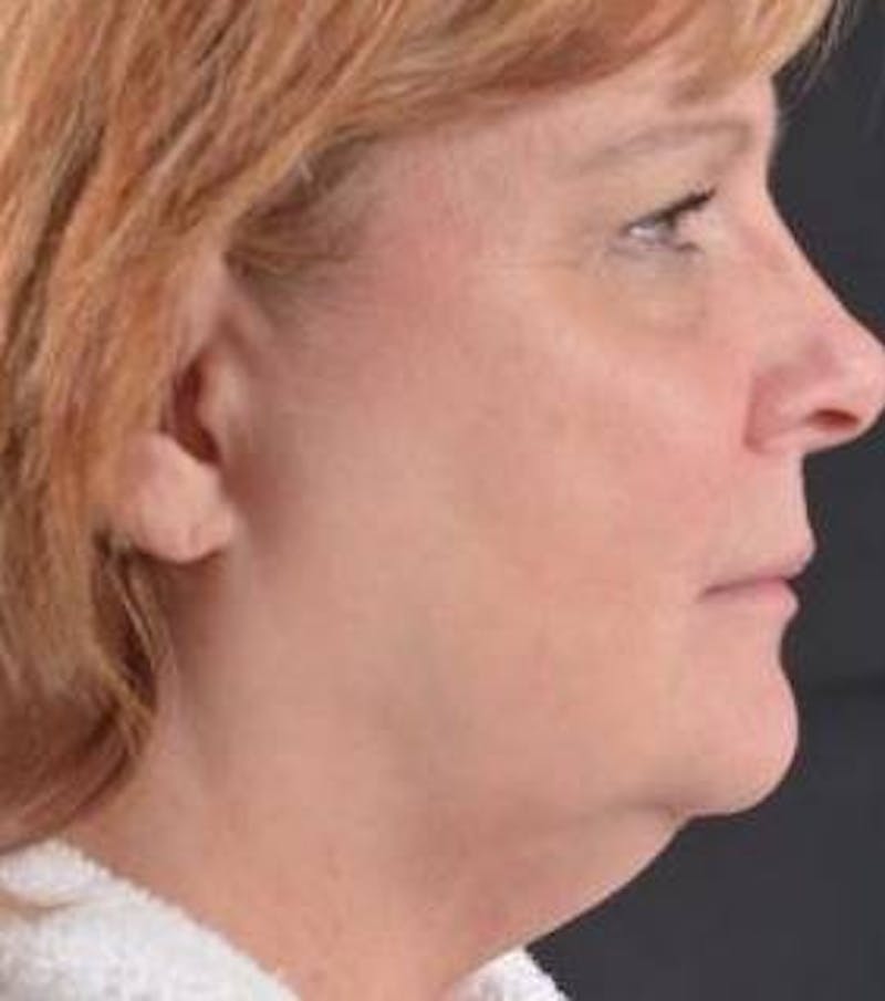 FaceTite Before & After Gallery - Patient 350944 - Image 5