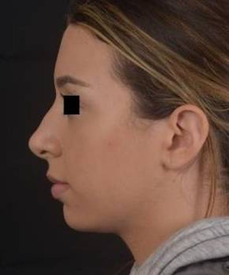 Rhinoplasty Before & After Gallery - Patient 156464 - Image 3