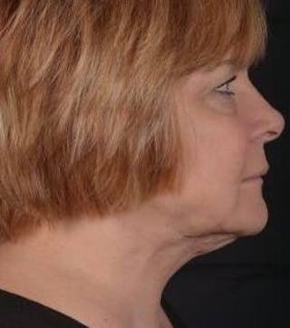 FaceTite Before & After Gallery - Patient 350944 - Image 6