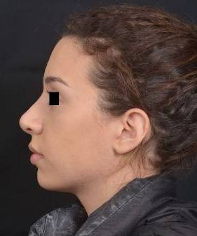 Rhinoplasty Before & After Gallery - Patient 156464 - Image 4