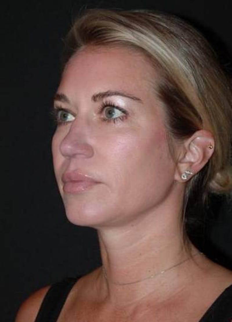 Necklift Before & After Gallery - Patient 128429 - Image 4