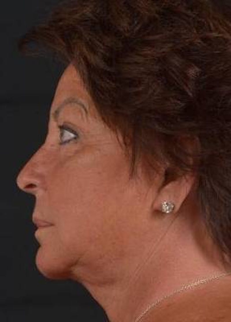 Facelift Before & After Gallery - Patient 107378 - Image 3