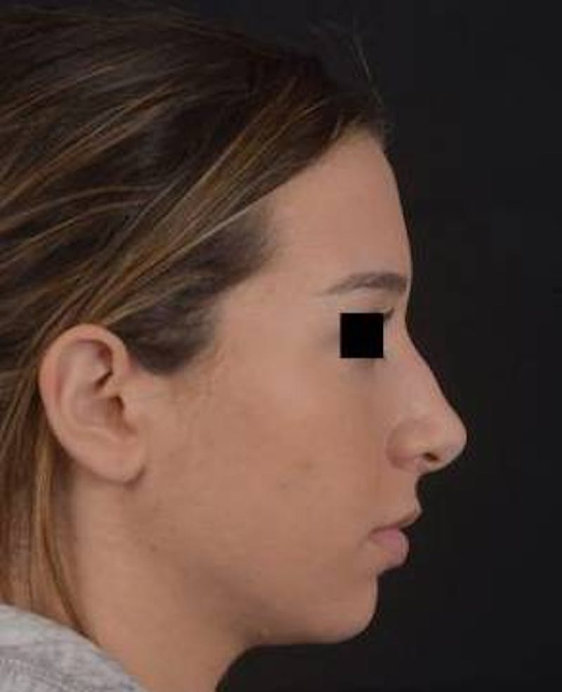Rhinoplasty Before & After Gallery - Patient 156464 - Image 5