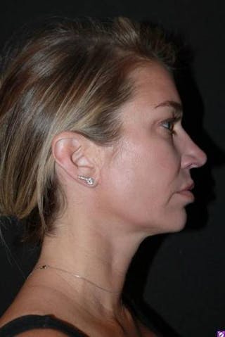Necklift Before & After Gallery - Patient 128429 - Image 10