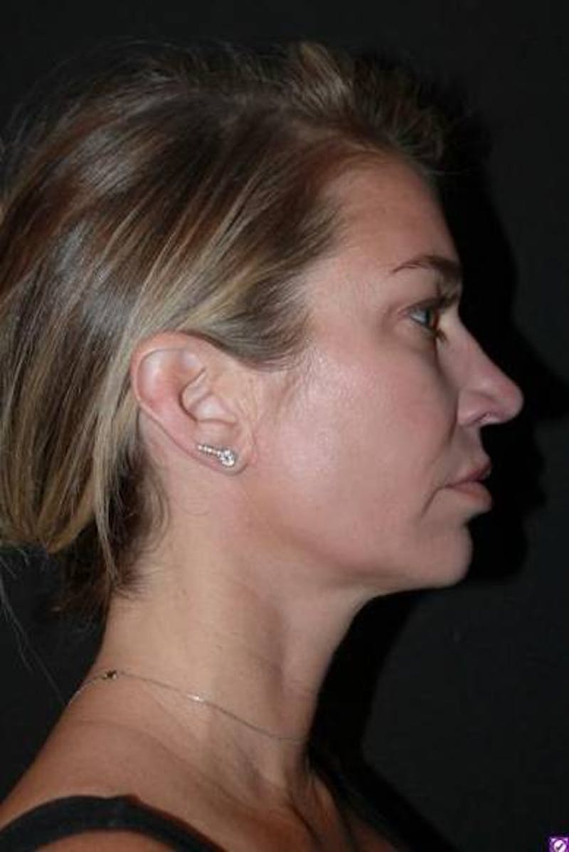 Necklift Before & After Gallery - Patient 128429 - Image 10