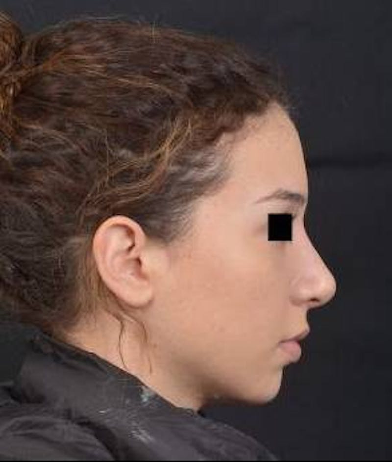 Rhinoplasty Before & After Gallery - Patient 156464 - Image 6