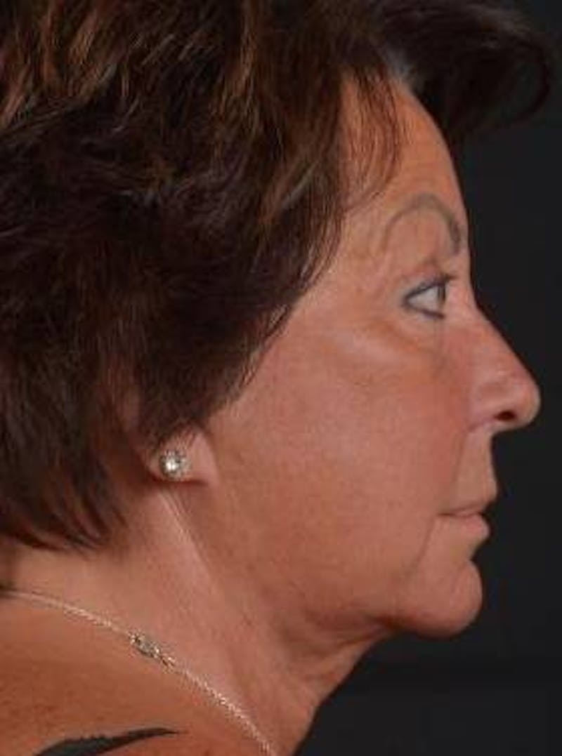 Facelift Before & After Gallery - Patient 107378 - Image 5
