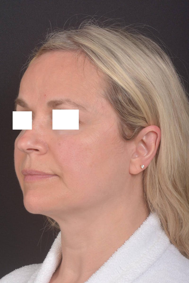 FaceTite Before & After Gallery - Patient 225509 - Image 7