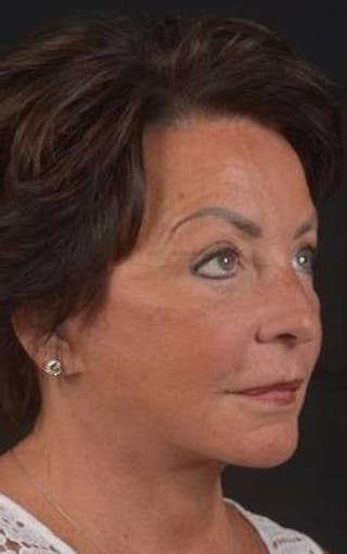 Facelift Before & After Gallery - Patient 107378 - Image 8