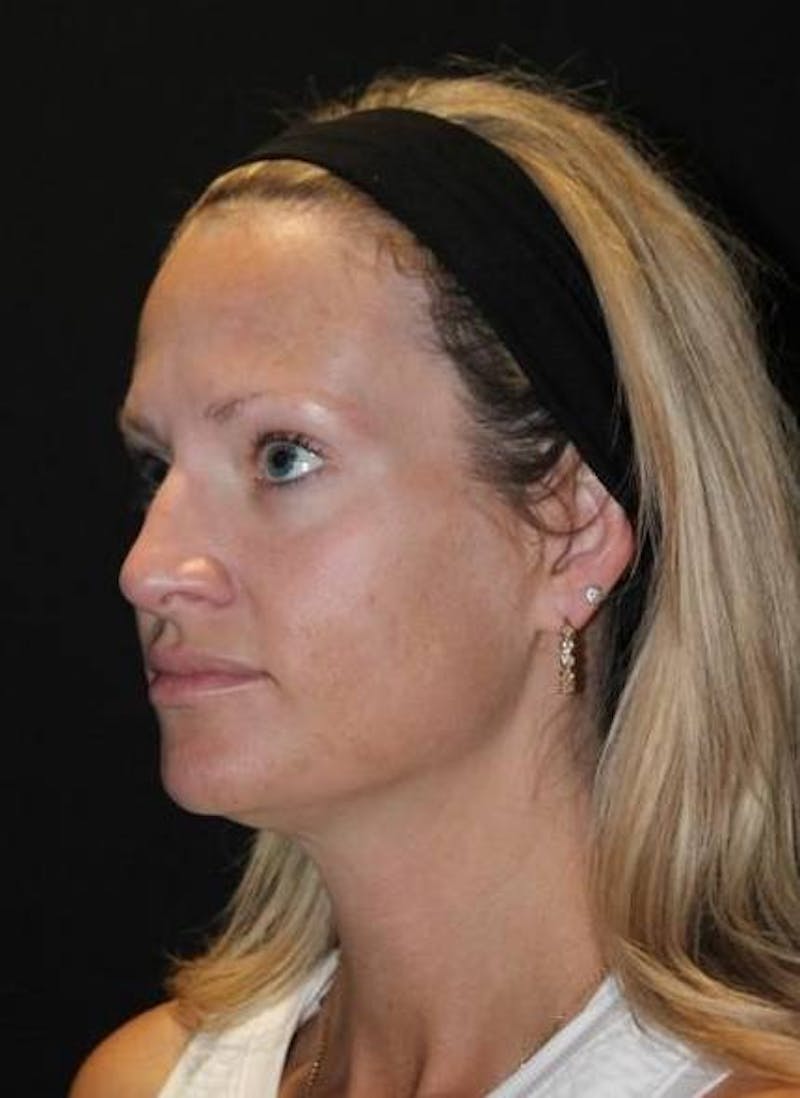 Necklift Before & After Gallery - Patient 556205 - Image 3