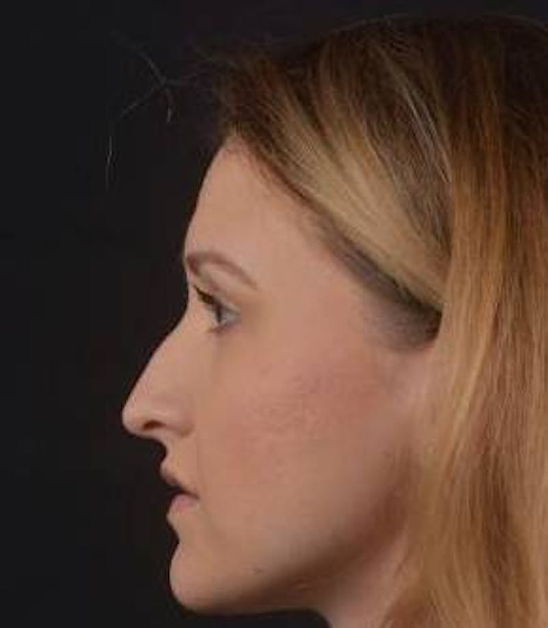 Rhinoplasty Before & After Gallery - Patient 407500 - Image 3