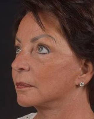Facelift Before & After Gallery - Patient 107378 - Image 10