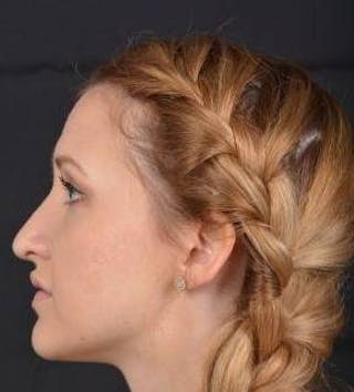 Rhinoplasty Before & After Gallery - Patient 407500 - Image 4